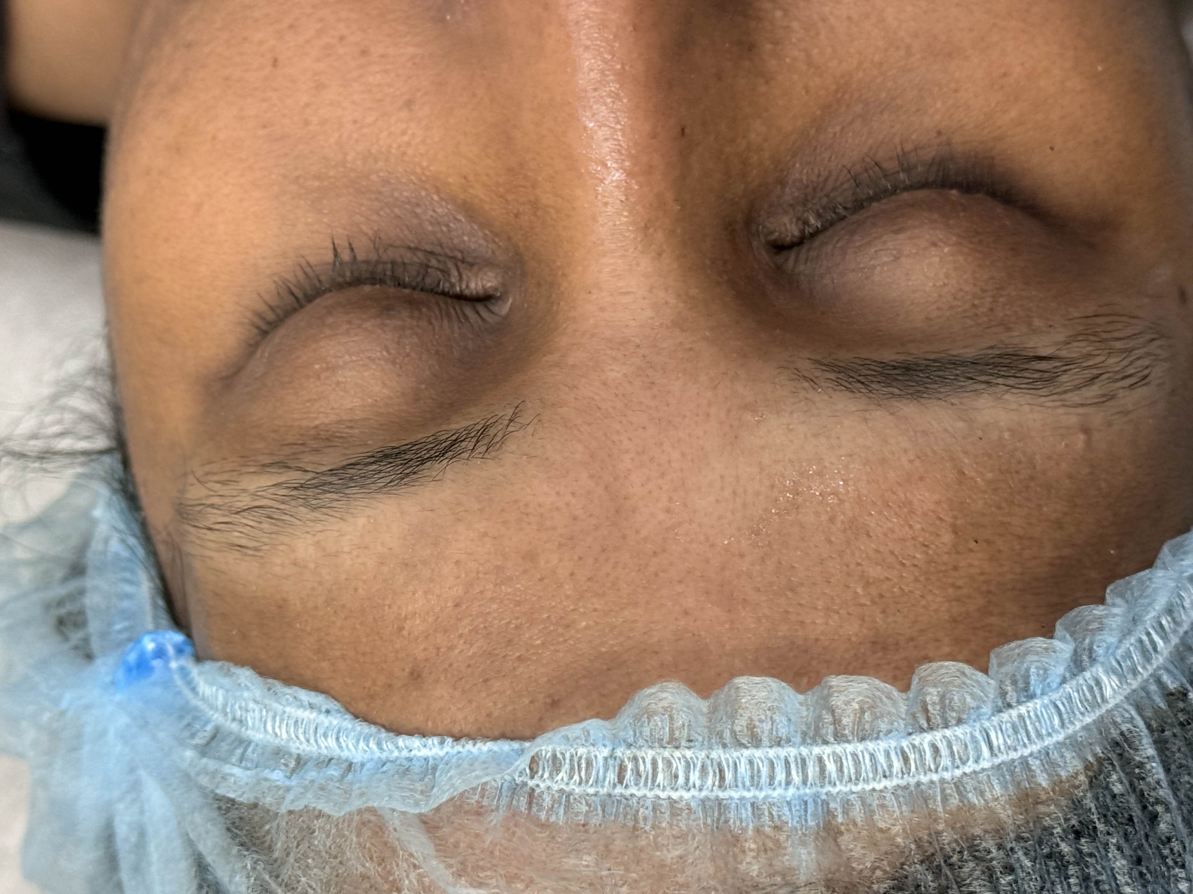 Before Treatment